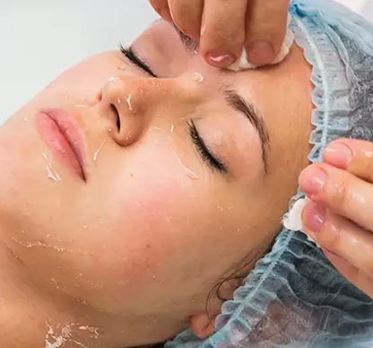 TCA Peel – Deep Resurfacing for Scars